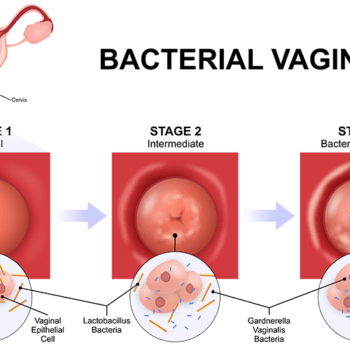 bh-1300x500-GIM-Vaginose Vaginose
