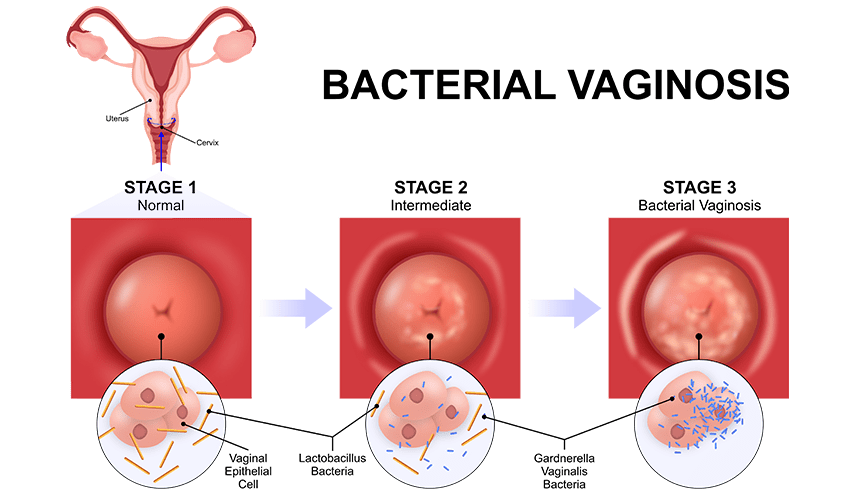 bh-1300x500-GIM-Vaginose Vaginose