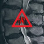 Spinalkanalstenose