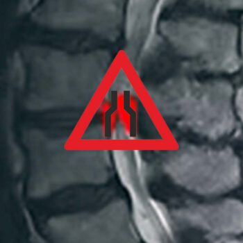Spinalkanalstenose