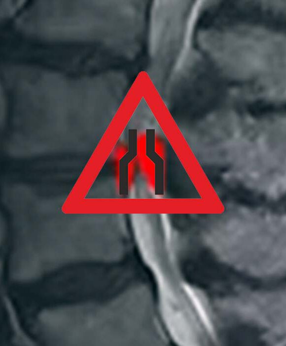 Spinalkanalstenose