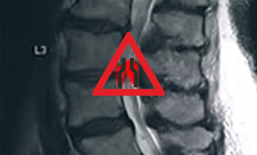 Spinalkanalstenose