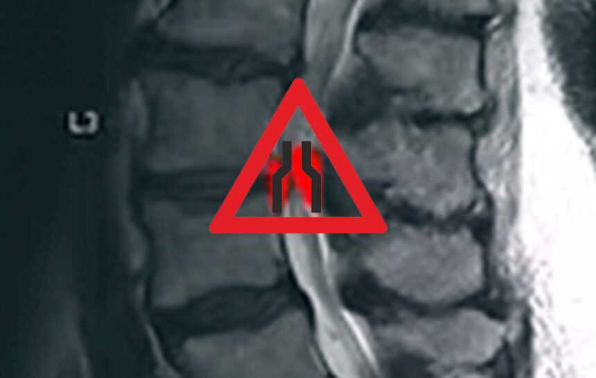 Spinalkanalstenose