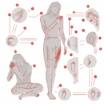 Fibromyalgie