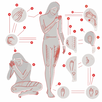 Fibromyalgie