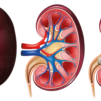Nierensteine