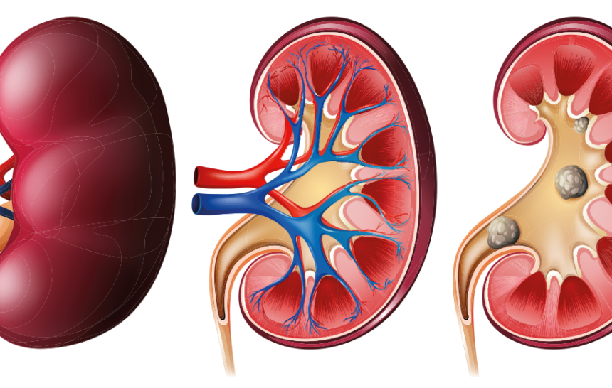 Nierensteine