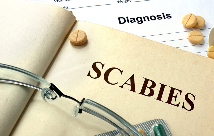 SCABIES