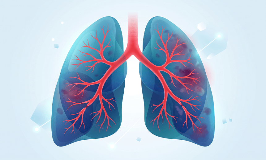 Bronchitis