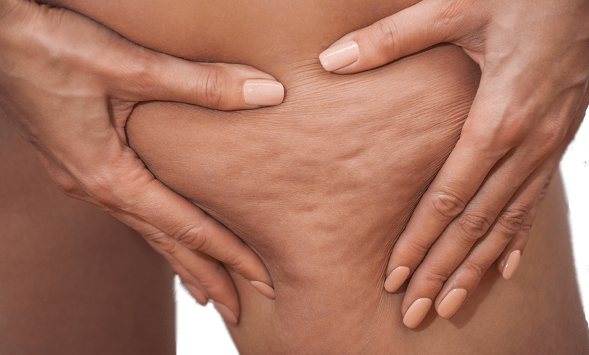 Cellulite