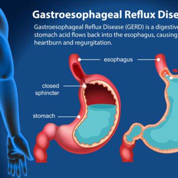 gim_bh_860x519-GERD-04 GERD