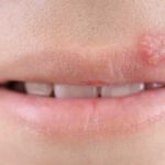 Lippenherpes