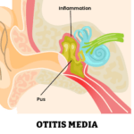 Mittelohrentzuendung-