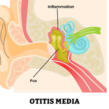 gim_bh_860x519-Mittelohrentzuendung-04 Mittelohrentzuendung-