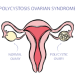 PCOS