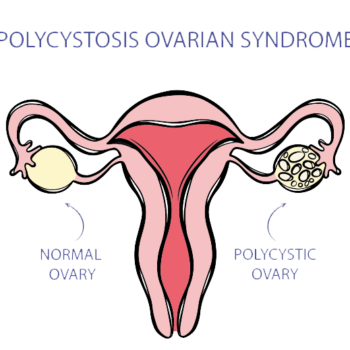gim_bh_860x519-PCOS-04 PCOS