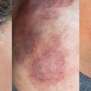 gim_bh_860x519-ringworm-04 Ringelflechte