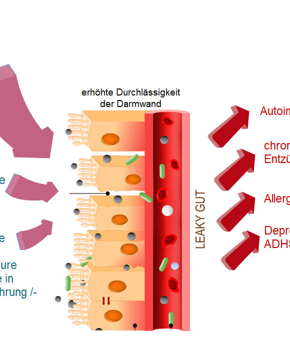 Leaky-Gut-Syndrom (LGS)