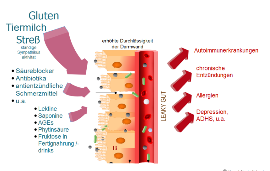 Leaky-Gut-Syndrom (LGS)