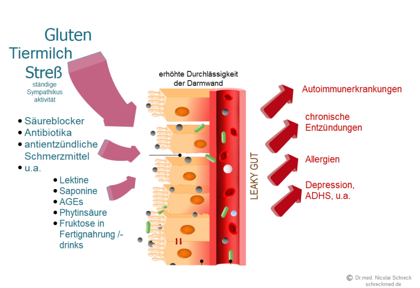 Leaky-Gut-Syndrom (LGS)