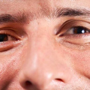 Chronisch progressive externe Ophtalmoplegie (CPEO)