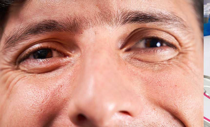 wi_bh_860x519-Strabismus-01 Chronisch progressive externe Ophtalmoplegie (CPEO)