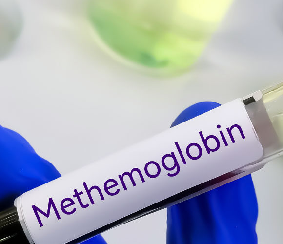 Methaemoglobinaemie